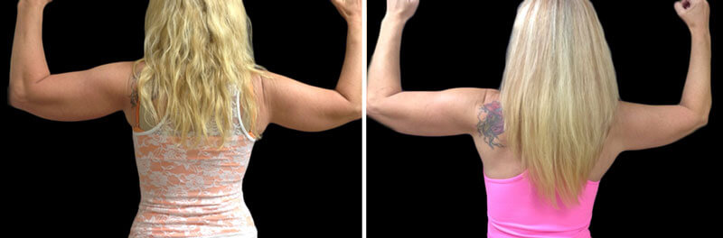 before and after coolsculpting arms treatment