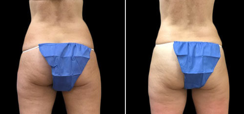 before and after coolsculpting flanks treatment