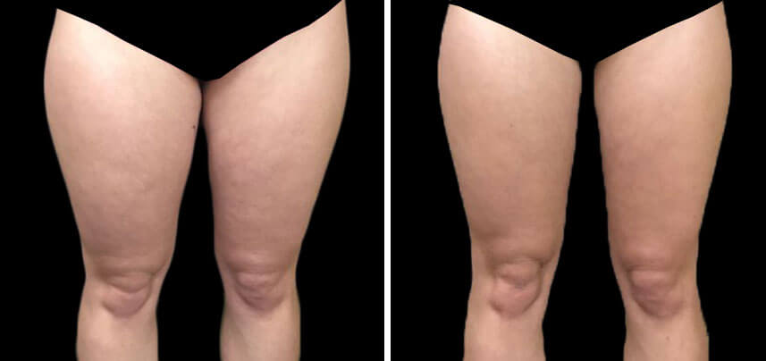 before and after coolsculpting leg treatment