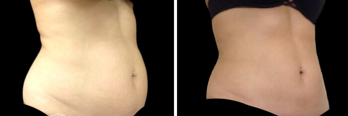 before and after coolsculpting abdomen treatment